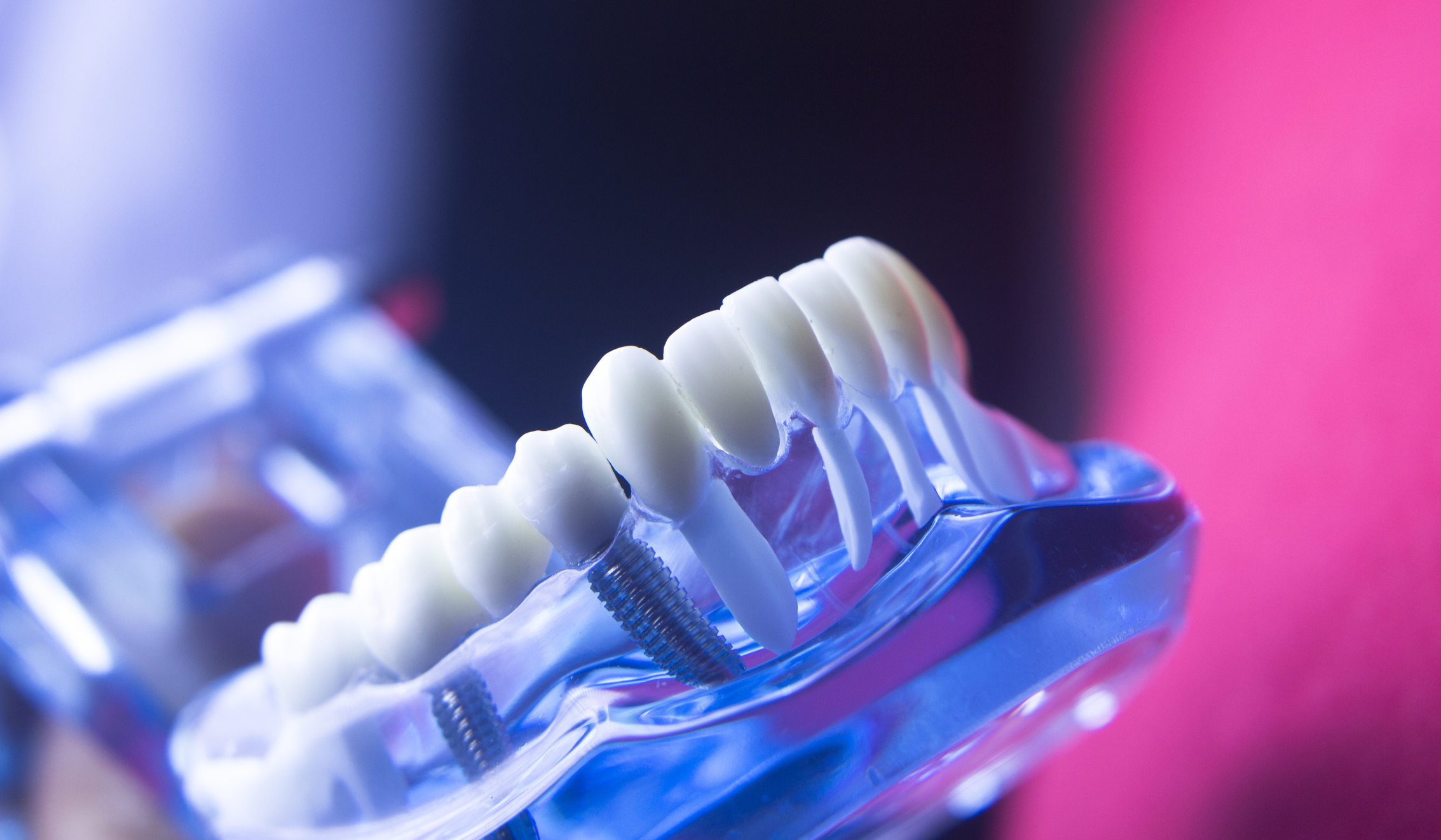 Case Studies: Innovative Implant Solutions in Canada